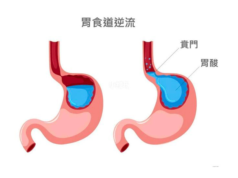 4種方法紓緩胃食道逆流