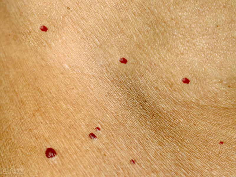 身上紅痣原來是血管瘤? 身上紅痣原來是血管瘤?