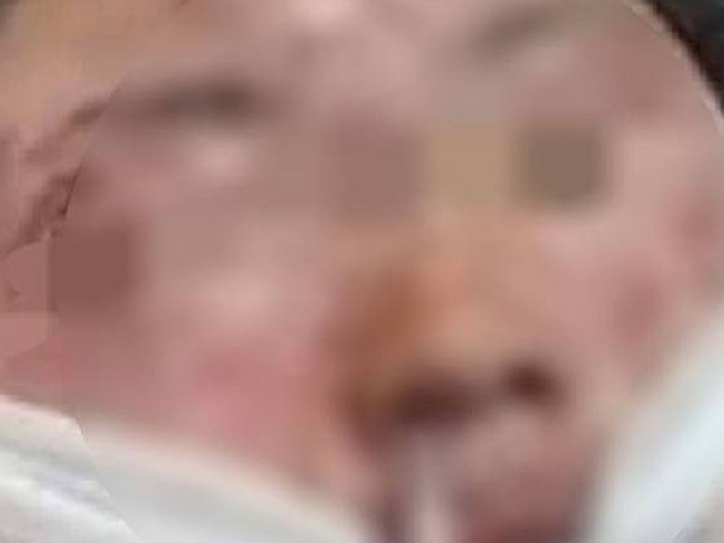 回家狂噴酒精 點蚊香起火 28歲女嚴重燒傷 回家狂噴酒精 點蚊香起火 28歲女嚴重燒傷