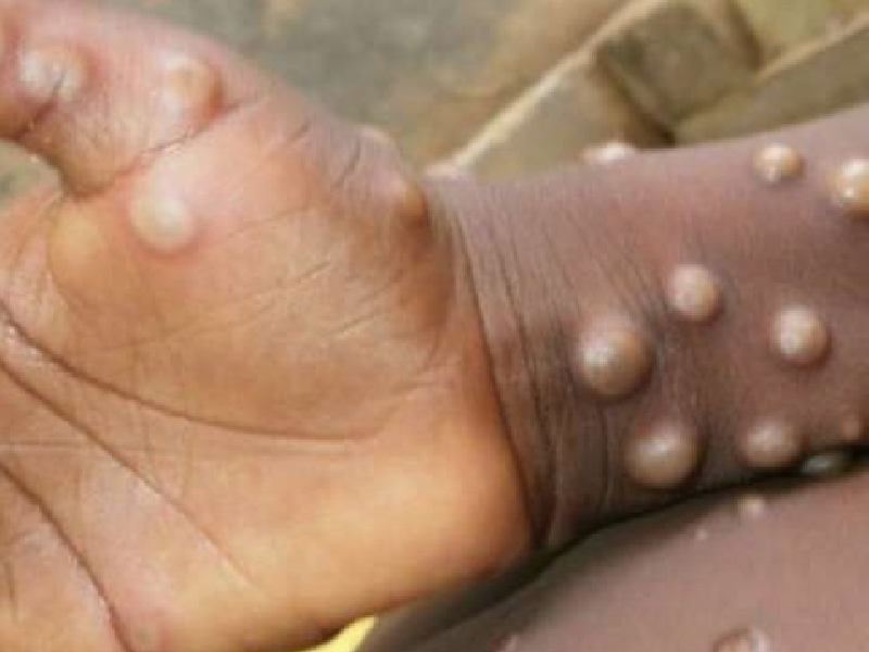 猴痘 Monkeypox 全球膿瘡病毒病例破千