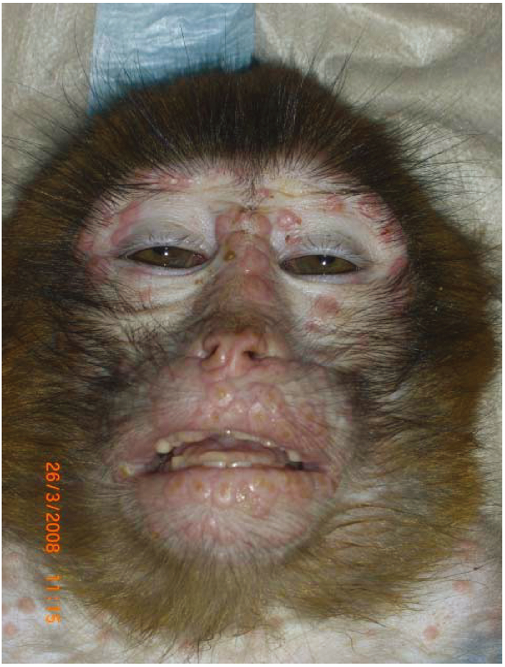 猴痘 Monkeypox 全球膿瘡病毒病例破千