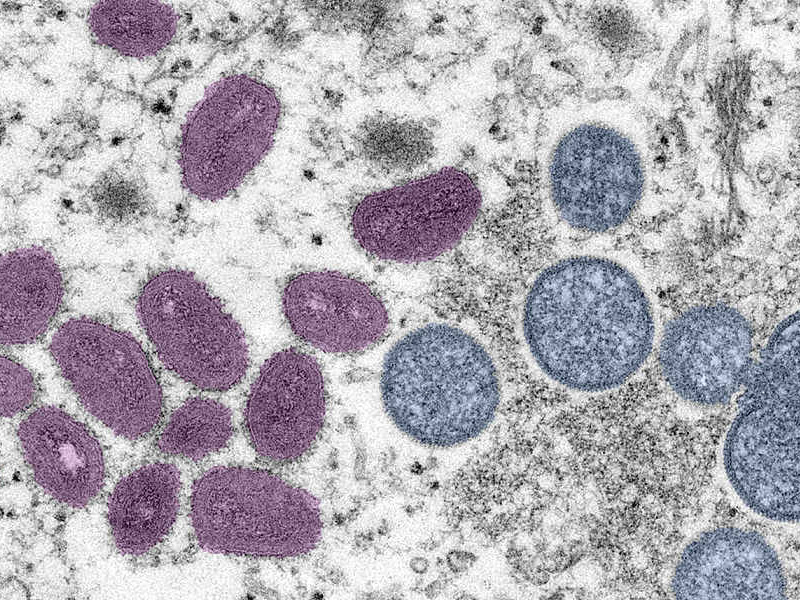 男子同時感染猴痘、新冠和艾滋病 為全球首例