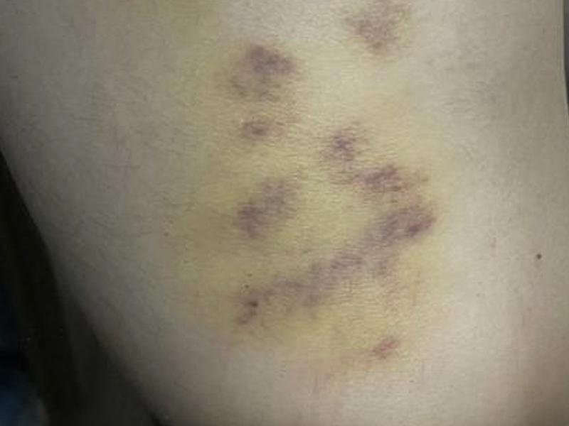 熱石按摩 按到要睇骨科