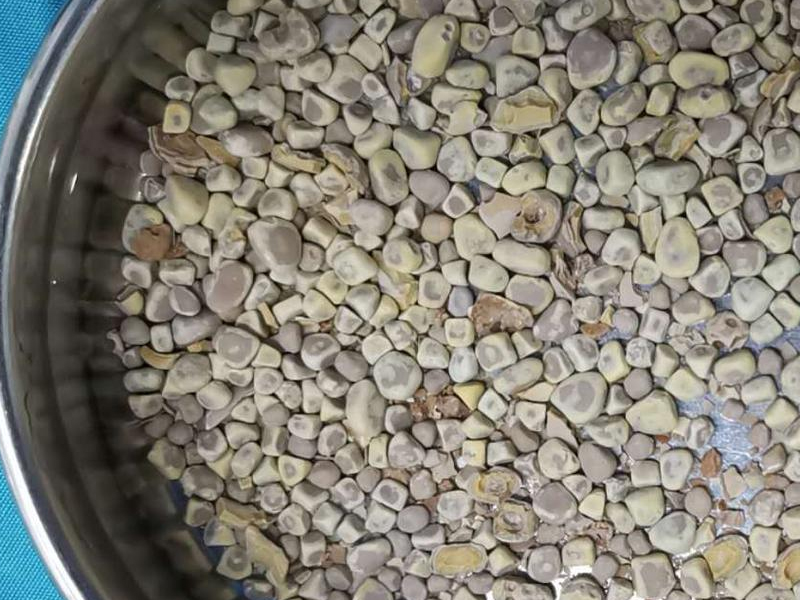 有這 4 種習慣 特別容易有腎結石 有這 4 種習慣 特別容易有腎結石