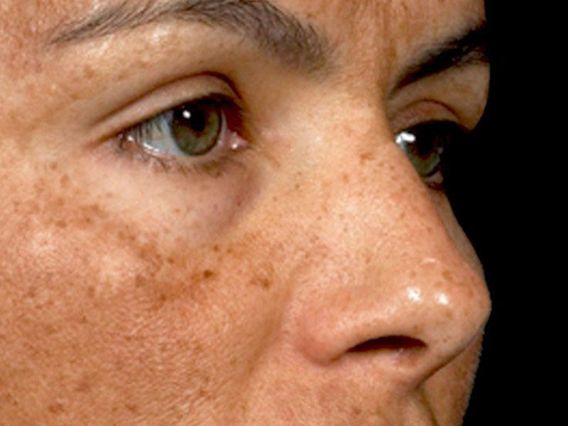 這 5 個部位長黑斑,可能腸胃癌變 這 5 個部位長黑斑,可能腸胃癌變