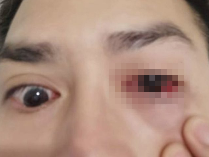 新恐怖變異毒株 感染後眼睛會長這樣 新恐怖變異毒株 感染後眼睛會長這樣