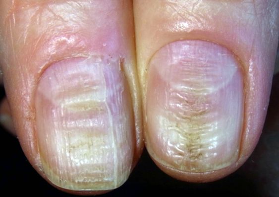 指甲出現 4 異常，是癌或疾病的預警