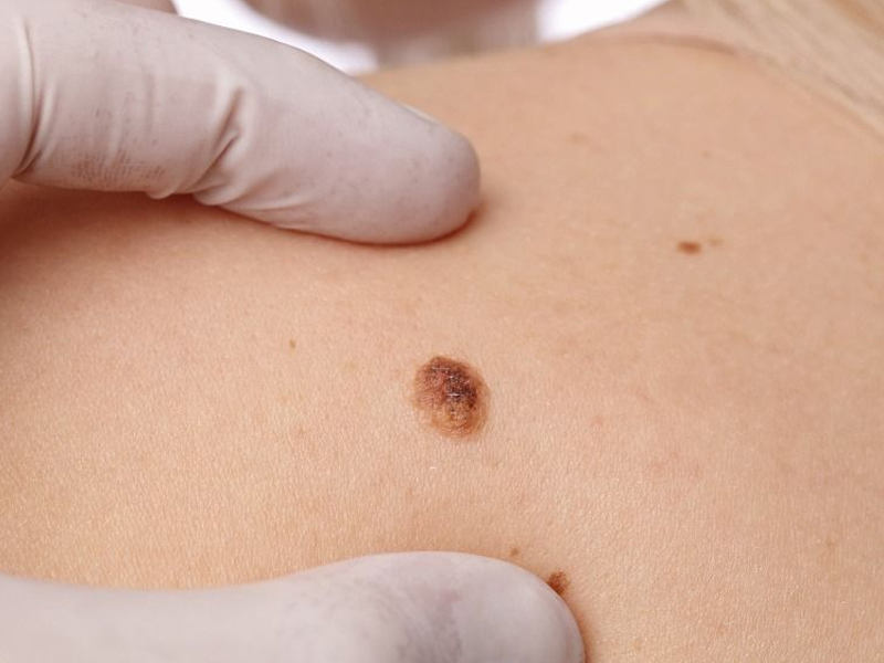 痣出現 3 狀況，快去身體檢查，可能是癌症