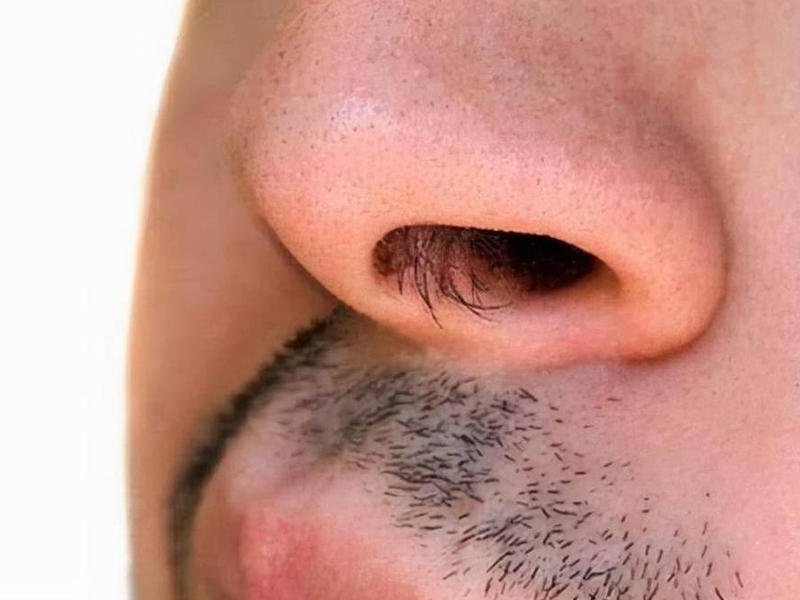拔鼻毛會增加罹患痴呆風險
