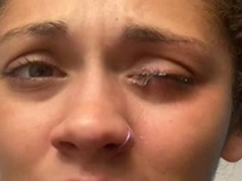 誤把強力膠當眼藥水