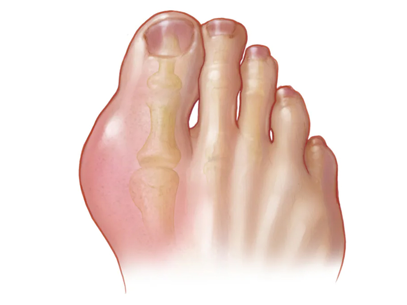 4 個現象，證明你已經有痛風了