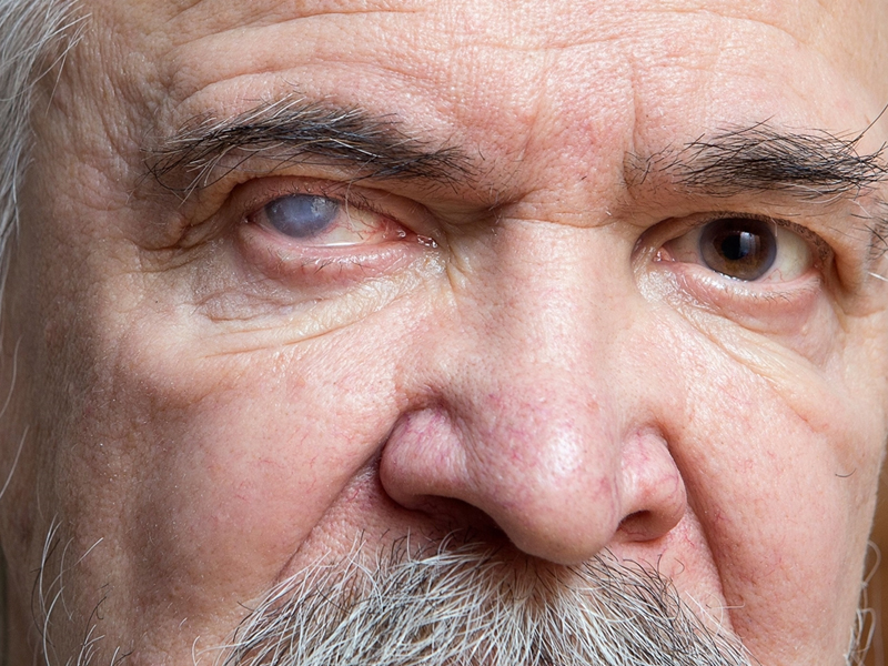 年輕人也會得白內障 這些症狀是前兆 年輕人也會得白內障 這些症狀是前兆