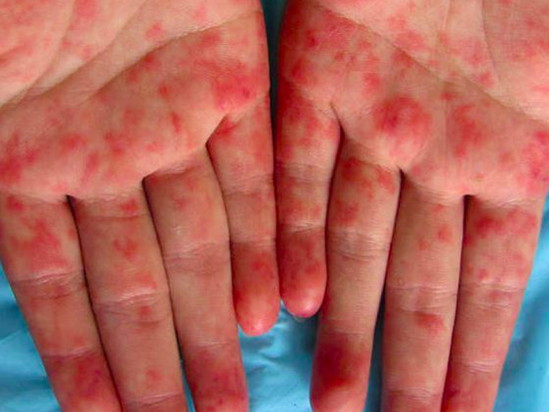 紅斑狼瘡，到底是種什麼病？