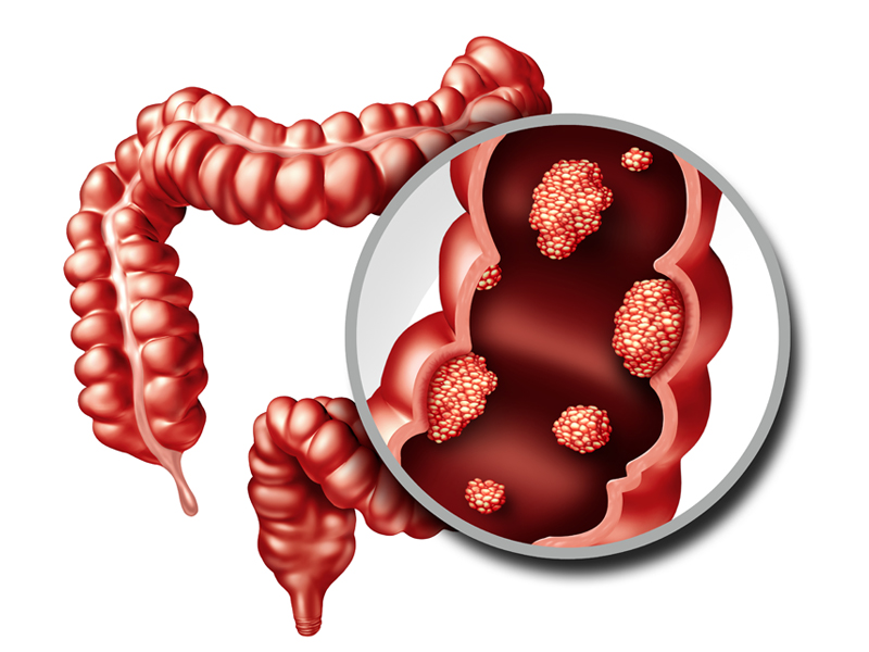 從確診到死亡僅僅 3 個月！小心大腸癌 4 症狀！