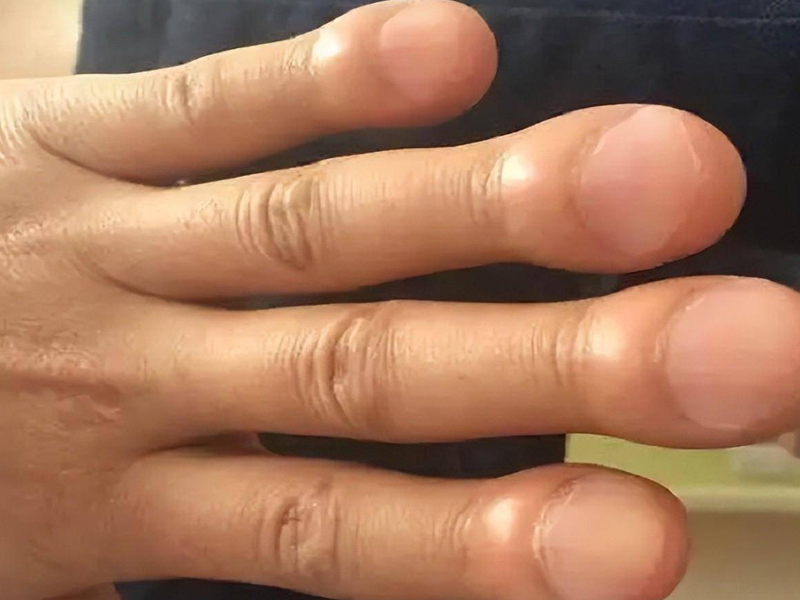 指甲一異常變化，恐是肺癌先兆