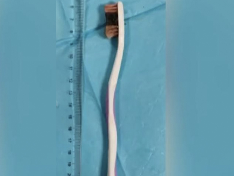 少年吞下牙刷，卡腸胃 48 小時才送醫