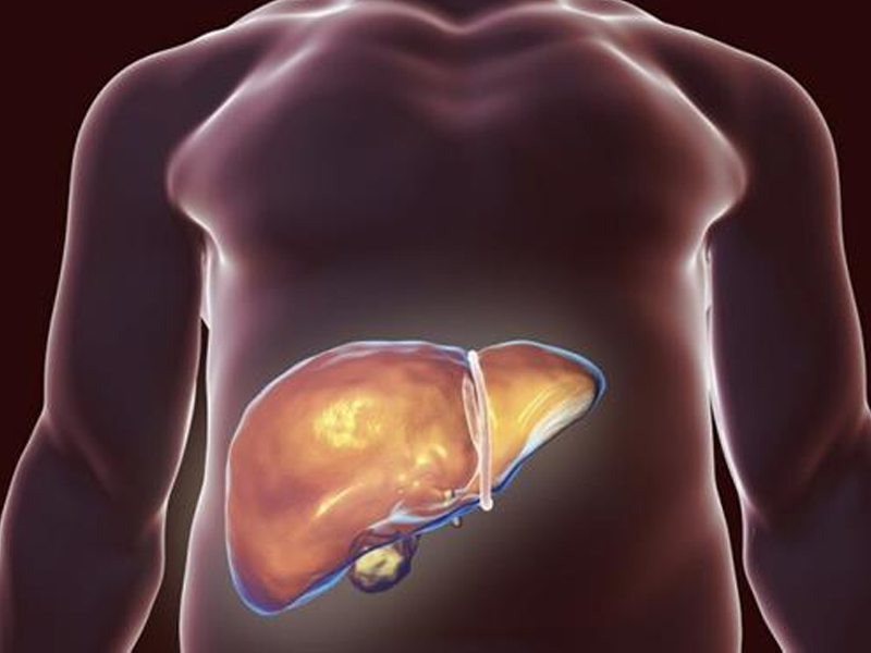 脂肪肝容易變成肝硬化、肝癌嗎？