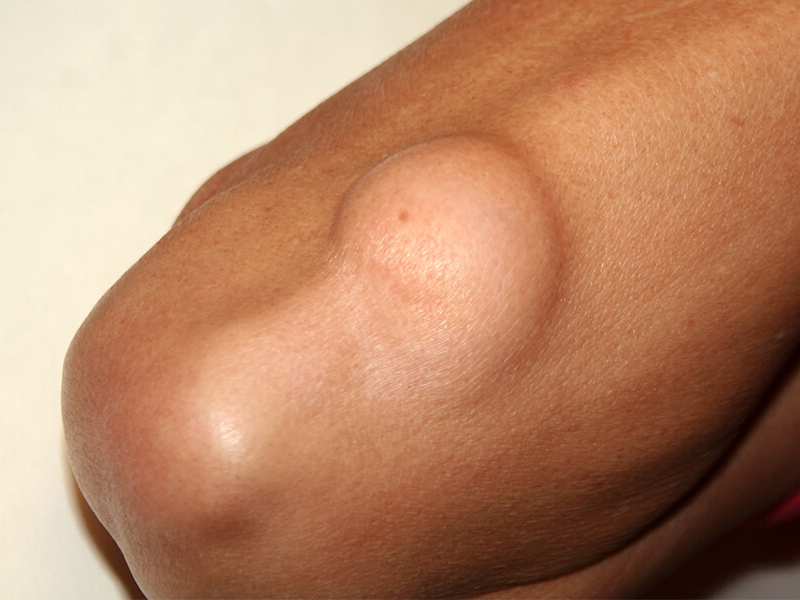 出現 9 個症狀,多數是惡性腫瘤 出現 9 個症狀,多數是惡性腫瘤