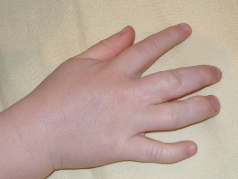 2歲小孩感染梅毒，原因竟然是 ...