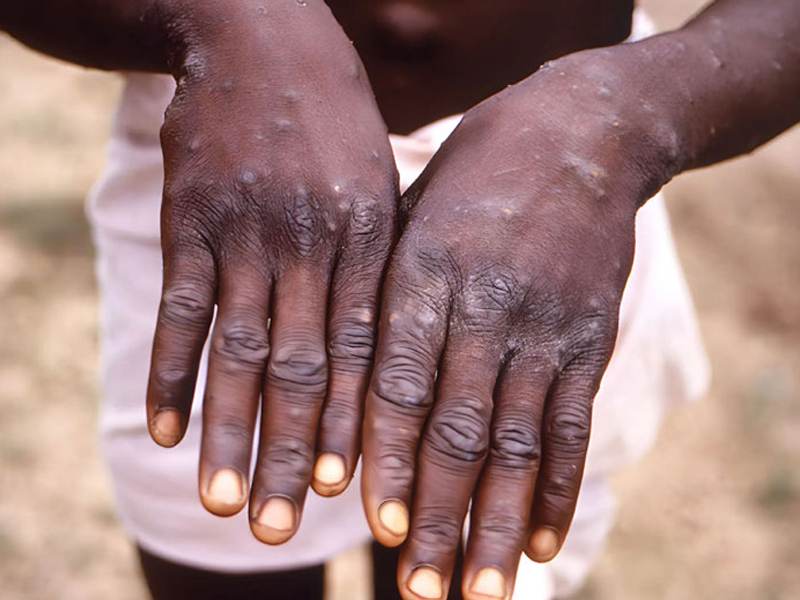 猴痘疫情再度升溫!世衛發佈國際緊急聲明 猴痘疫情再度升溫!世衛發佈國際緊急聲明