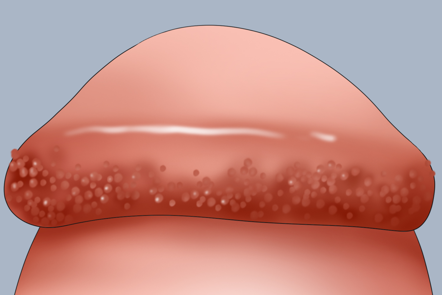 男性感染 HPV 有什麼症狀？