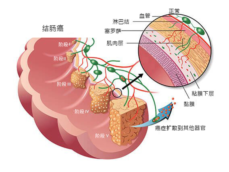 男子大腸癌 4 期！每天一食物癌細胞未再復發