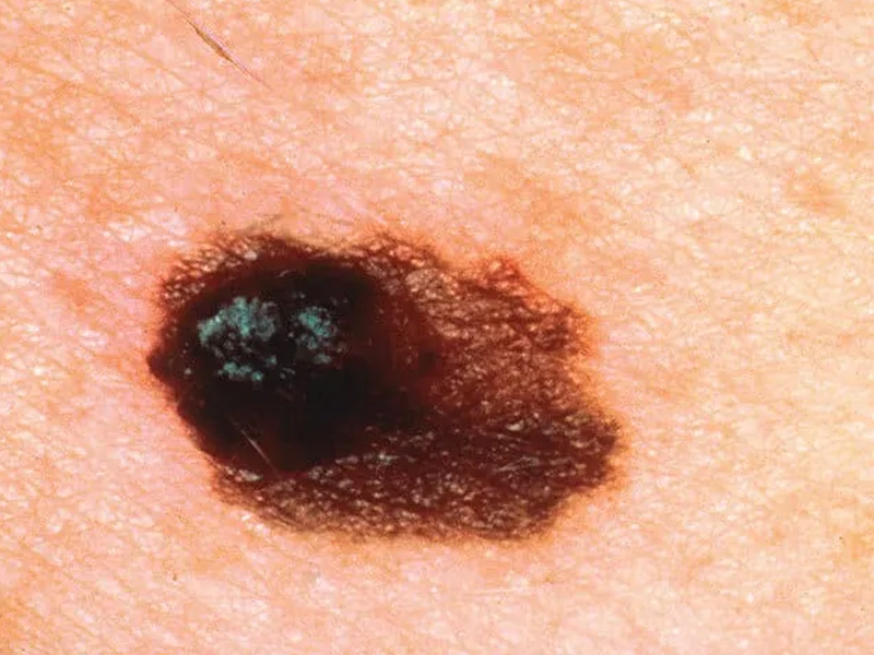 身上黑點是痣還是癌?無視黑點恐失早期治療良機 身上黑點是痣還是癌?無視黑點恐失早期治療良機