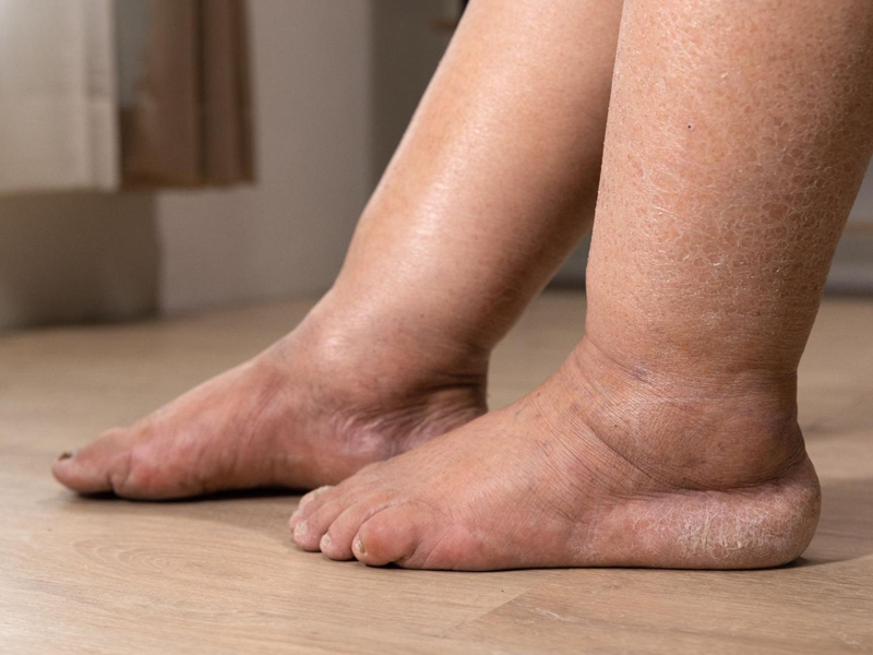 腿部出現 3 症狀,肺部可能已癌變 腿部出現 3 症狀,肺部可能已癌變