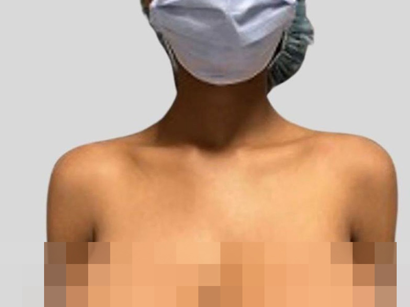 19 歲少女接種輝瑞疫苗後,胸部變大三倍 19 歲少女接種輝瑞疫苗後,胸部變大三倍