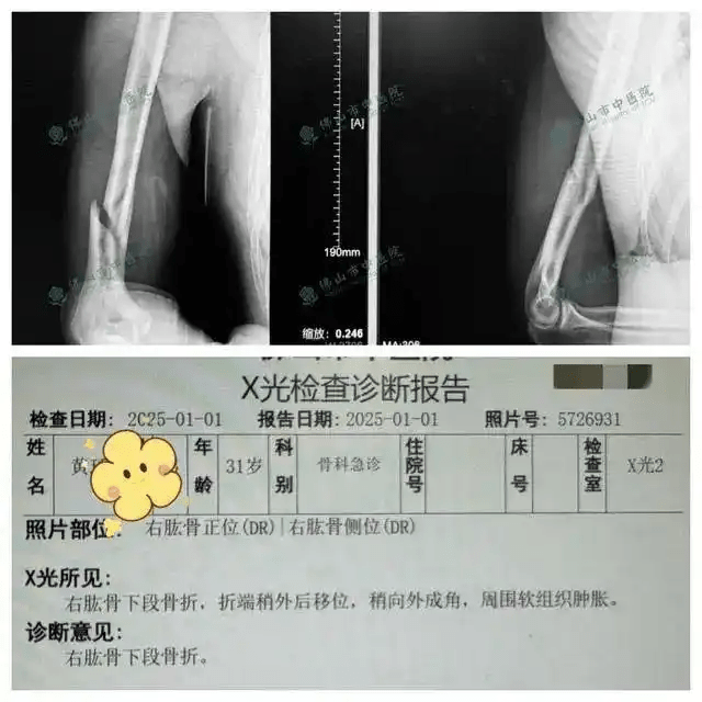 佛山男挑戰拗手瓜機械人，當場骨折