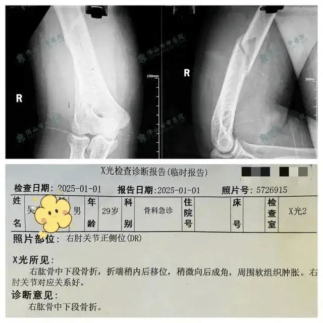 佛山男挑戰拗手瓜機械人，當場骨折