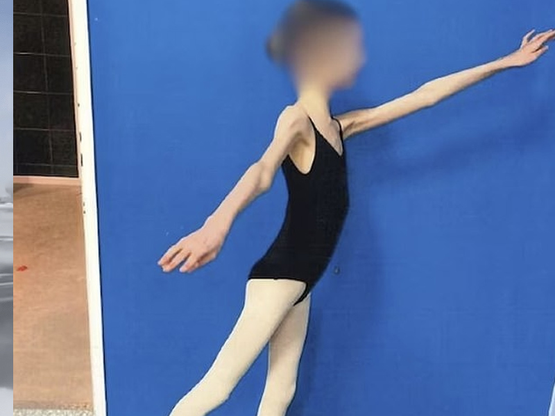 17 歲女營養不良，體重只有 27 kg