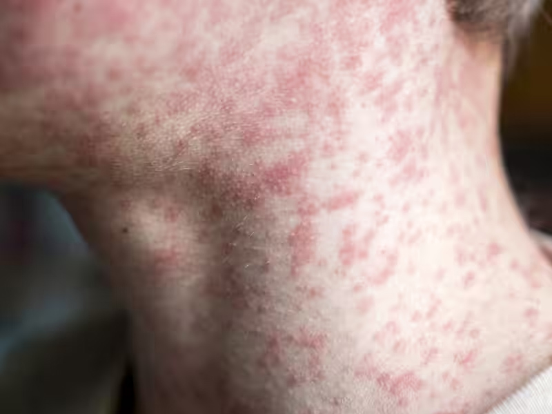 外地傳入麻疹，患者曾到訪體院餐廳