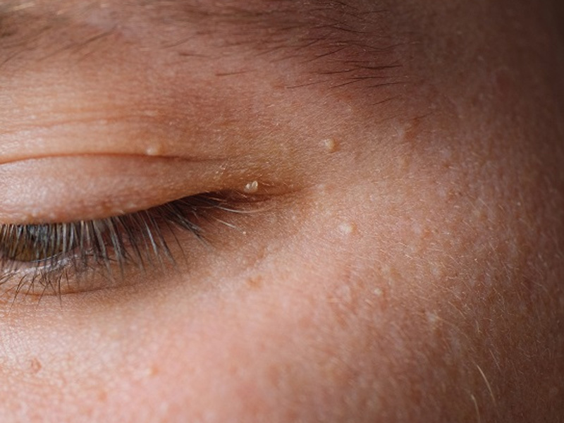 臉上小肉粒:油脂粒、疣如何分辨? 臉上小肉粒:油脂粒、疣如何分辨?