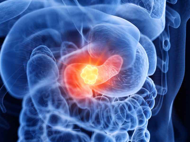 胰臟癌難發現，專家揭示常見症狀