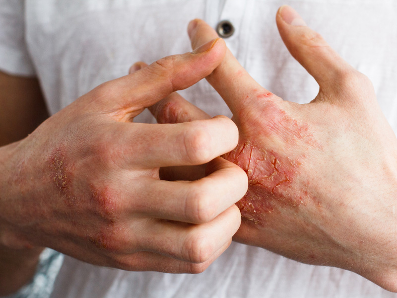 濕疹常見困擾問題,補益生菌能緩解症狀 濕疹常見困擾問題,補益生菌能緩解症狀