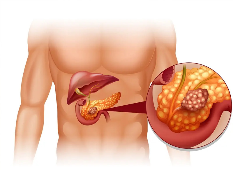 胰腺癌早期癥狀：腹痛、脂肪便需警惕