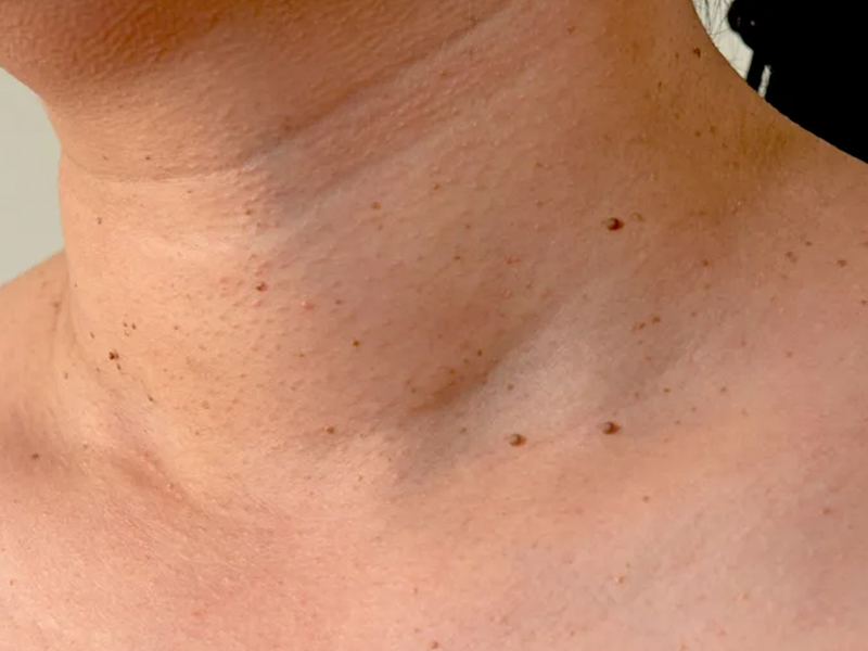 皮膚上長小肉芽，健康風險亮紅燈