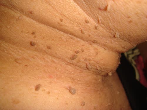 皮膚上長小肉芽，健康風險亮紅燈