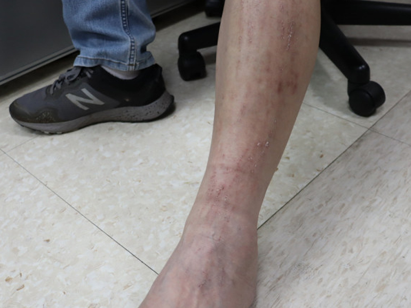 雙腿搔癢以為是過敏，一查竟然是肝癌