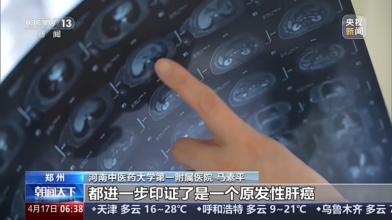 雙腿搔癢以為是過敏，一查竟然是肝癌