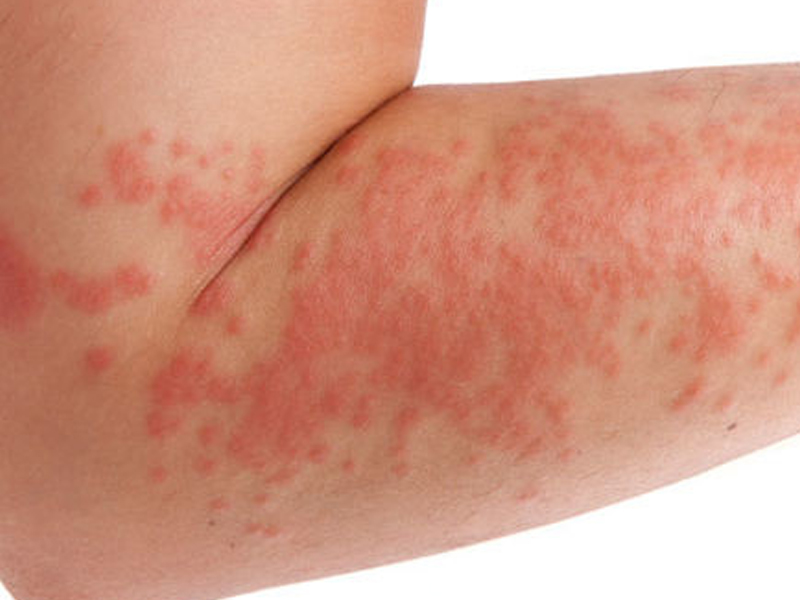 濕疹的成因及治療方法
