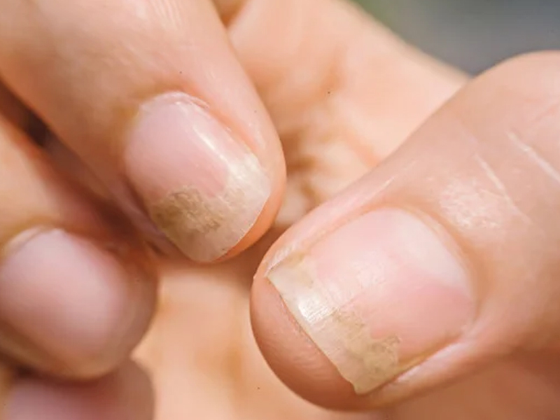 灰甲六大徵狀與感染風險