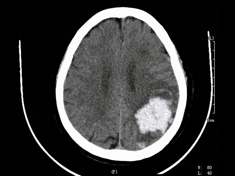 7 點起床 1 點睡覺，腦幹出血 ICU 抢救