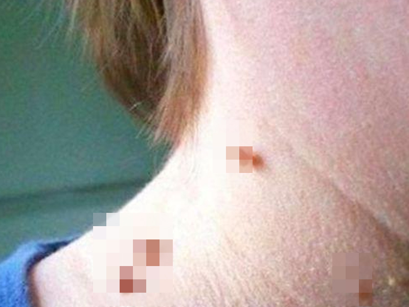 身上有這些小點必看！錯過黃金期就晚了