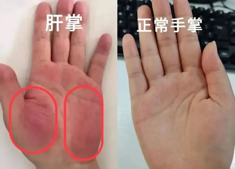 肝臟有癌，雙手先知