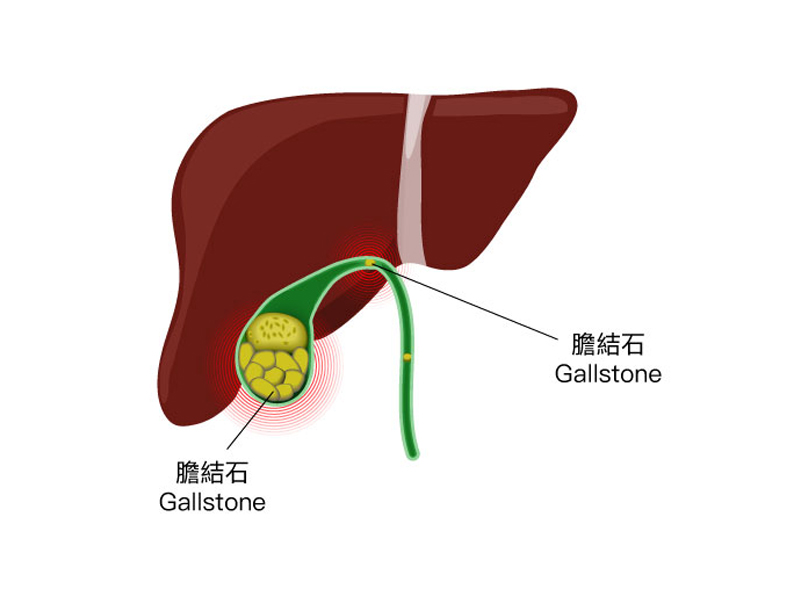 膽結石：成因、症狀及治療全解析