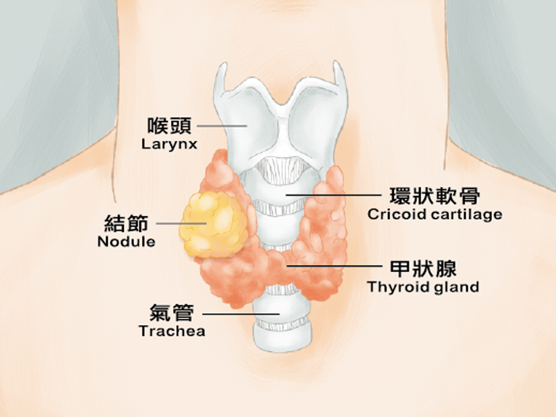 香港 10 癌 1 甲！甲狀腺檢查必須做