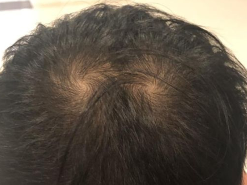 為什麼頭髮會有旋？為什麼有的人沒有旋