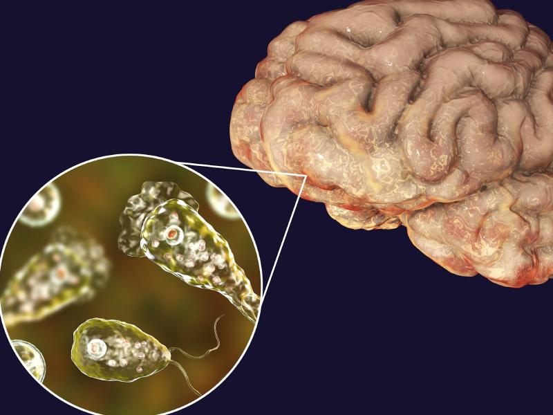 5 歲女童玩水後感染食腦蟲 5 歲女童玩水後感染食腦蟲